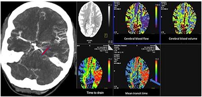 The Impact of Endovascular Rescue Therapy on the Clinical and Radiological Outcome After Aneurysmal Subarachnoid Hemorrhage: A Safe and Effective Treatment Option for Hemodynamically Relevant Vasospasm?